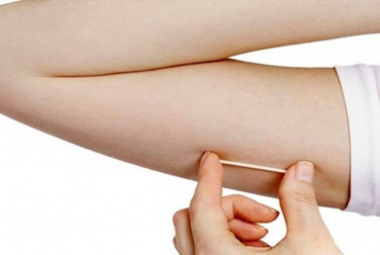 Nexplanon Contraceptive Implant
